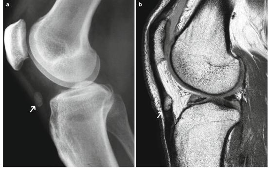 髕腱炎成為醫(yī)學(xué)焦點(diǎn)，從幕后走向舞臺(tái)中央的最新進(jìn)展