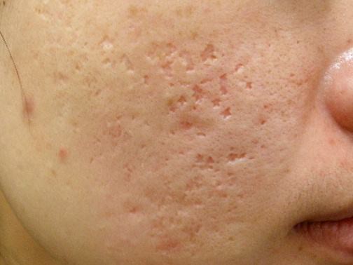 最新痘坑撫平神器，科技重塑肌膚之美，自信生活從此開始