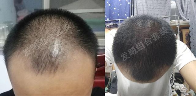 治愈脫發(fā)最新重大突破，重塑自信，希望之光再現(xiàn)