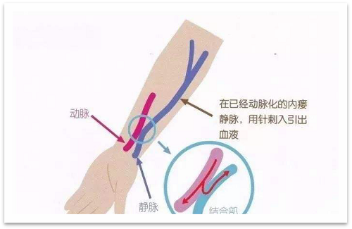 靜脈瘺最新資訊，掌握最前沿的健康信息